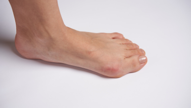 Hallux valgus – a misalignment of the big toe: causes, symptoms and information